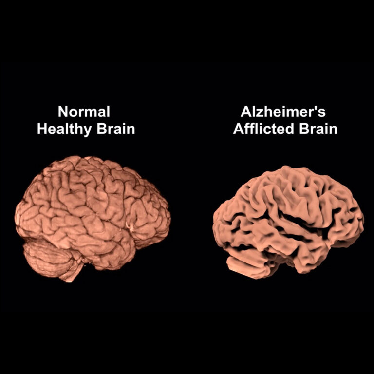 Infinitely Curious: When Memory Fades: Understanding Dementia | 22.03.2026